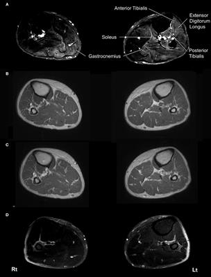 A Patient With Thiamine Deficiency Exhibiting Muscle Edema Suggested by MRI